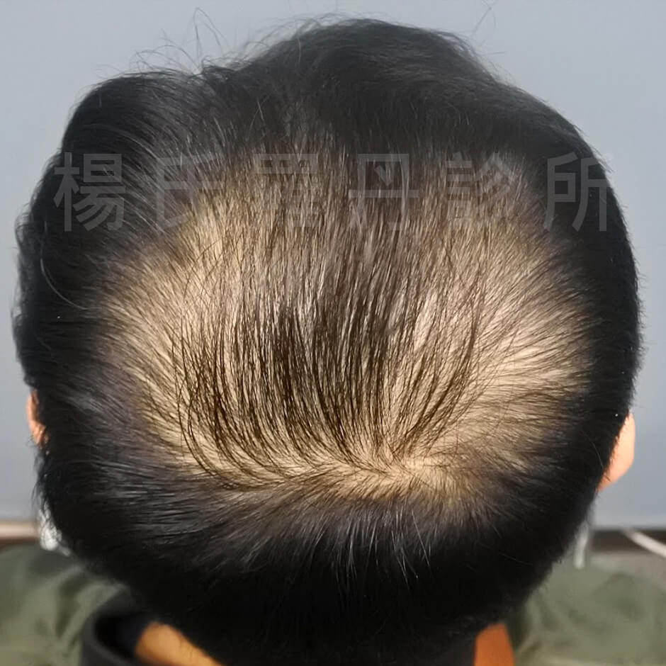 植髮 雄性禿 楊氏羅丹 生髮613 生髮